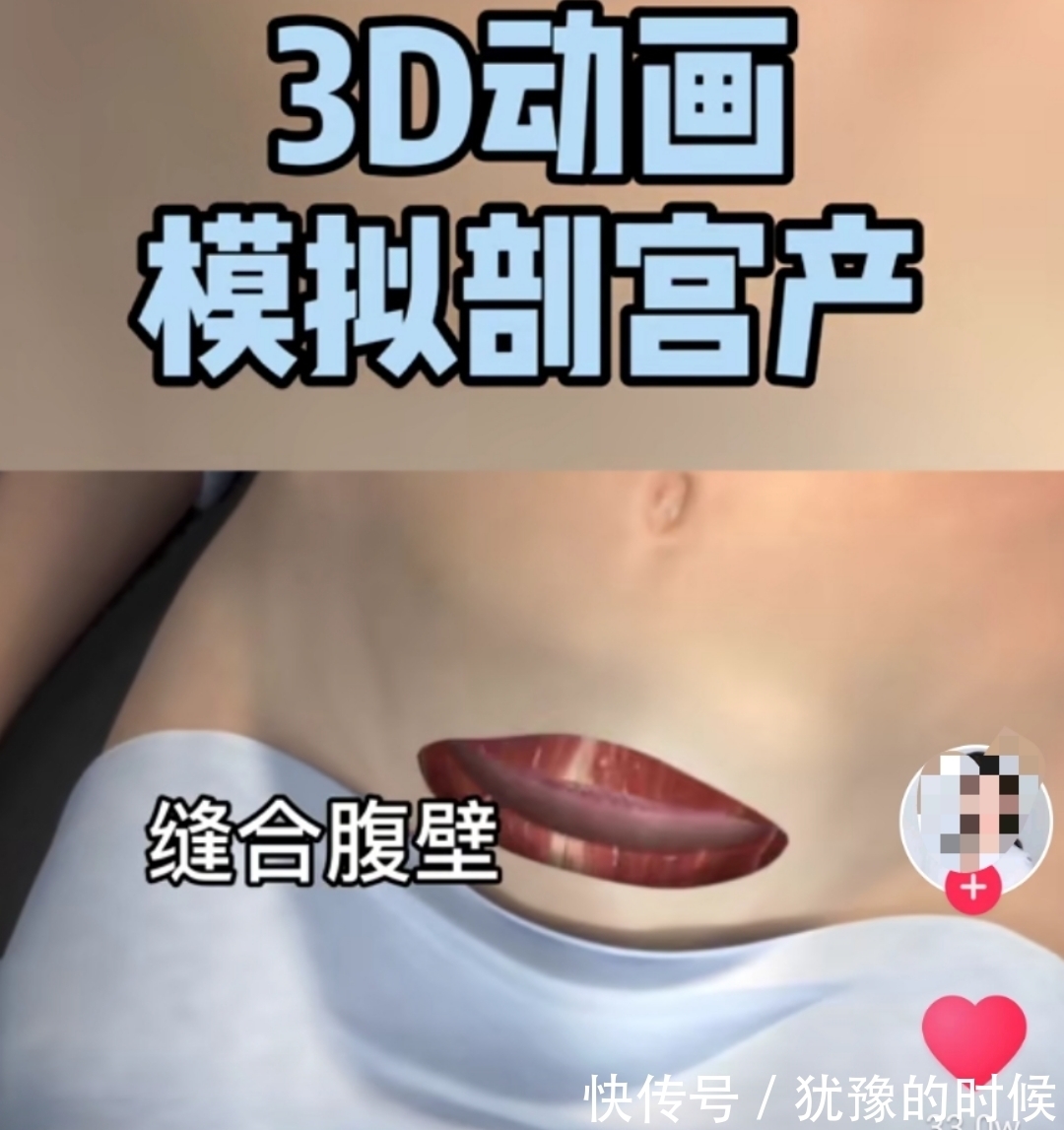 顺产|剖宫产有多“伤”妈妈,几张3D过程图带你了解,感恩老婆和妈妈