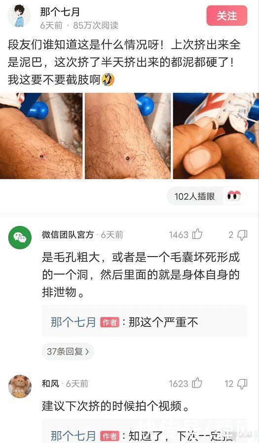 情况|这是什么情况，我这要不要截肢啊?注意力全在汗毛上