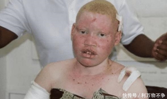 治愈|被人当成“唐僧肉”,血液比金子还贵,警察只能24小时保护他们