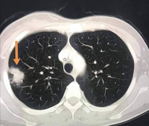 肺结节|癌症病人的幸运指数不一样，这位老太太想感谢一个吹破的肺大泡
