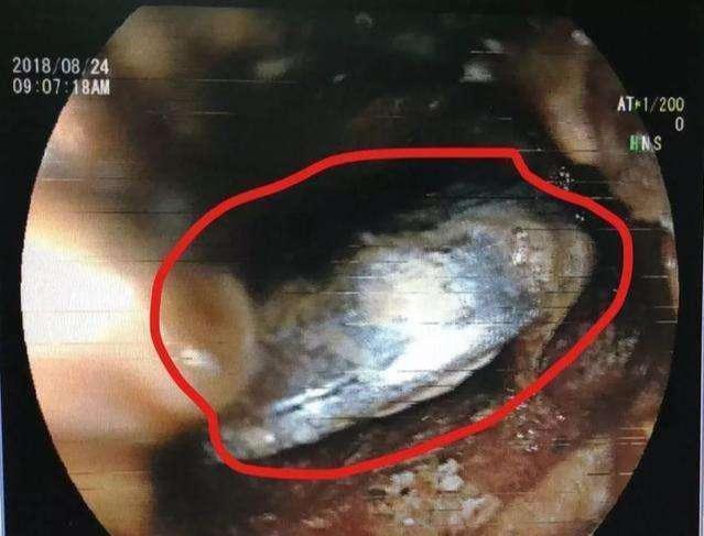 体温计|娃误食纽扣电池,妈妈“大题小做”的处理保住孩肠道,医生都称赞