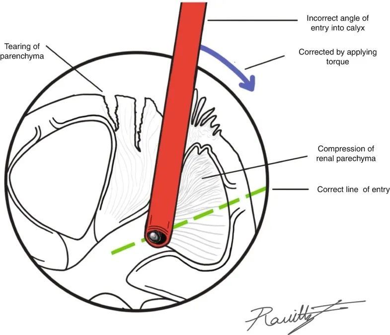 肾盏|PCNL为何会发生严重并发症及对策?