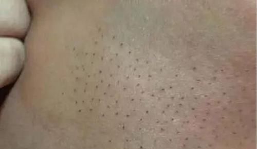 妈妈|妈妈发现宝宝的背上长满了''黑刺'',把刺一根根拔掉,医生检查后大骂无知