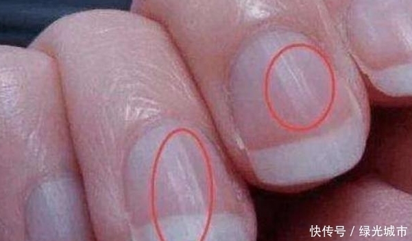不在乎|指甲上发现有“竖纹”,可能是这4种“情况”,别傻傻的不在乎