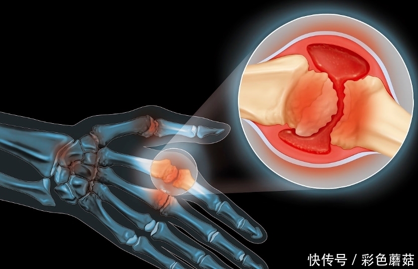  器官|早上起床时，身体若有5个“异状”，说明身体器官在“报警”！