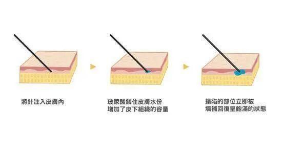 面部凹陷太显老，想要变回少女脸，你得这样做！