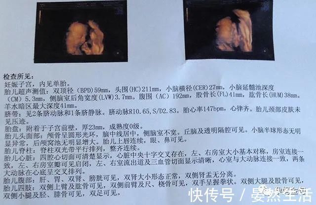 健康|怀孕后,怎么分辨宝宝是否健康?除了做“唐筛”,还有这四个方法
