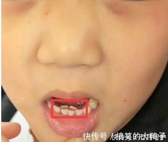 双排牙|6岁孩子长出双排牙,赶紧带去医院检查,得知原因宝妈后悔不已