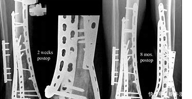 骨科医生：5种骨折不归骨科管！看病别再走错了