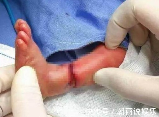 小晓|胎儿在妈妈肚子里腿被“绑绳”,孩子刚出生,医生可能要截肢