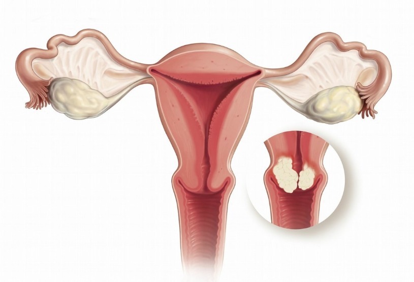 子宫颈癌|宫颈癌有5大诱因，中一个就要当心，2招清除HPV，宫颈癌躲着走