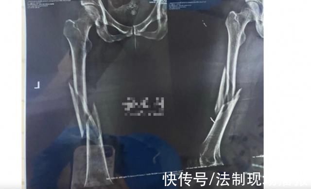 李女士|女子第一次上瑜伽课被老师压断腿，店家赔5万想了事:不再赔偿，可以走司法途径