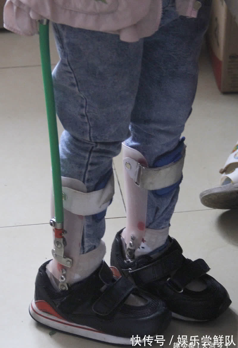 帕金森|女孩长相甜美,因发育迟缓不会说话,妈妈为其日夜操劳患上帕金森