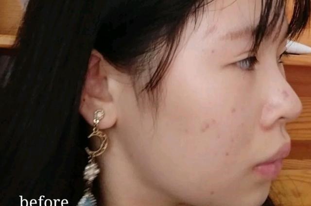 假体 假体下巴这个手术对下庭改善大吗!