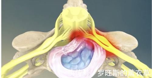 颈椎|头晕头痛？脖子酸痛？手麻？颈椎病这个“流行”病要注意