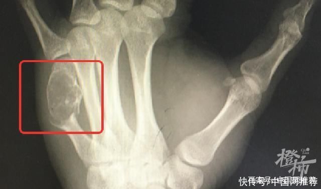 医生|杭州一程序员手疼7年没在意，医生:骨头快成“豆腐渣”了