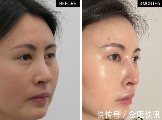 泪沟 求美者很想撤回的照片,真实记录泪沟、鼻修复术后3个月效果变化!