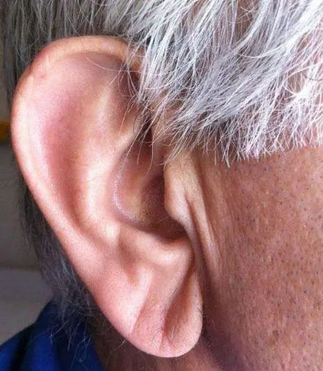 血脂升高|血脂高不高,看脸上三个地方就知道,降血脂四种食物一口别吃