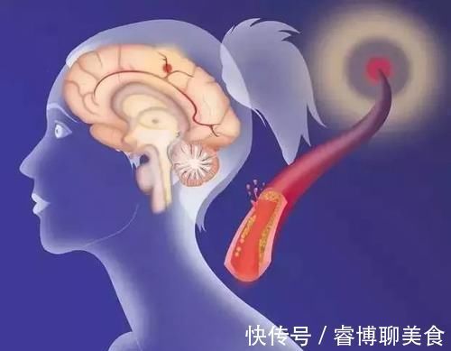 堵塞|血管堵塞不用怕，日常多食用此几物，帮你疏通血管，远离三高