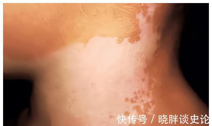 小女孩|宝宝的胎记怎么来的?产科医生:孕期这2种行为易长胎记,要避开