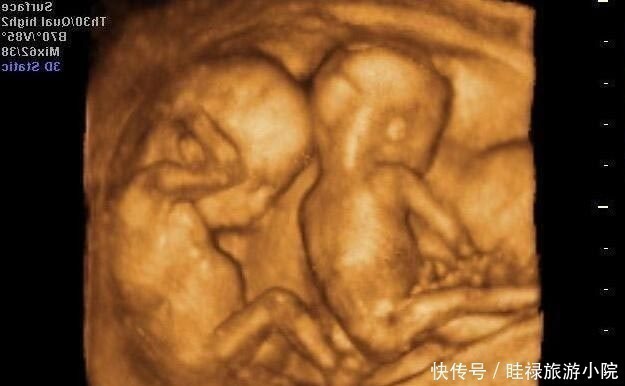 医生|孕期产检不想生个“傻孩子”,这三项产检必须按时做,不能忽视