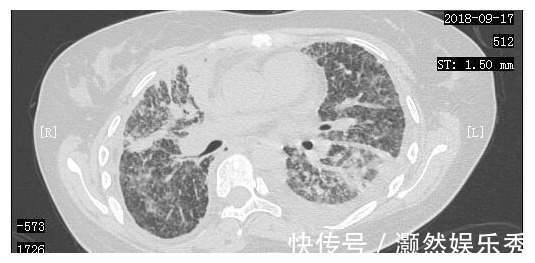 癌细胞|23岁女孩癌细胞全身扩散，一年抗癌出奇迹