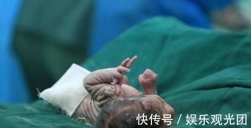 出血量|剖腹产,竖切口和横切口有什么区别?作为产妇,应该怎么选择