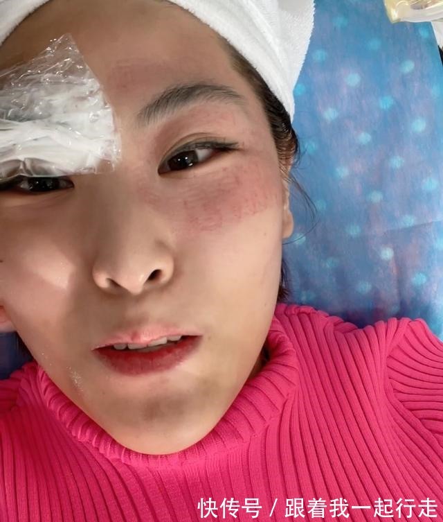 黄金微针 号称“小热玛吉”的黄金微针你了解吗!