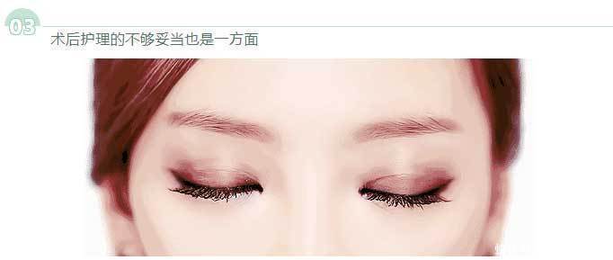 恢复|为啥割了双眼皮以后,你恢复的比别人慢