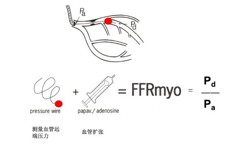 冠状动脉|【健哥说心脏】想知道心肌缺血有多严重？这个“分数”很准确