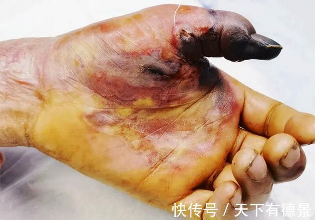 钓友|摘钩时被黄辣丁刺伤,指头被截险丧命,详解正确摘鱼方法