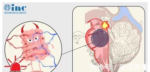 婴孩|孕妈瘫痪,竟是脑干肿瘤出血作祟,脑干手术后诞下婴孩造医学奇迹