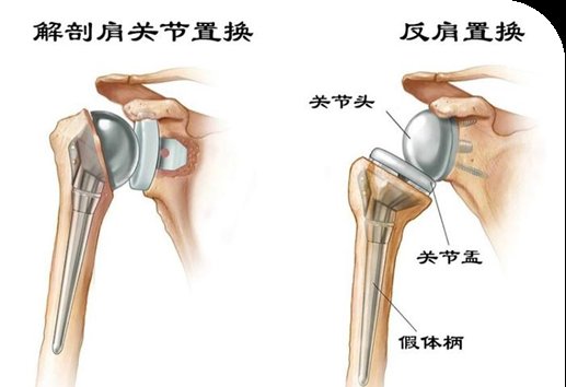 置换术|肩关节装反了？别慌！看潍坊市人民医院专家如何为患者解除病痛