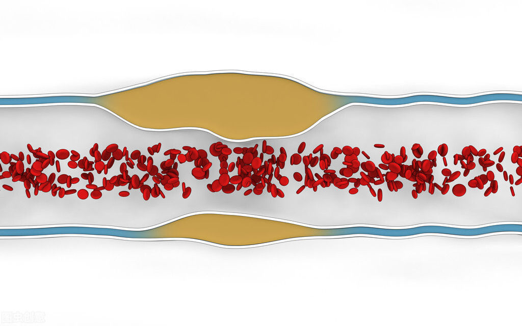 血管壁|血管变硬有多可怕？不仅如此，这2种血管问题也要命