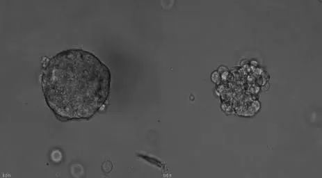 胰腺癌|培养皿中种出肿瘤,为癌症患者打开希望之门!