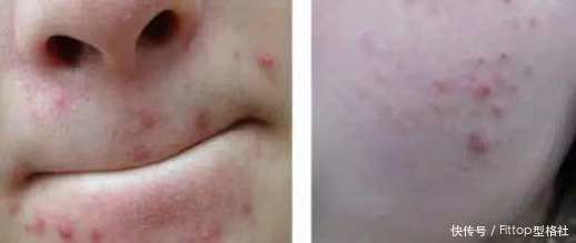 非兔|痘痘好不了?正确的战“痘”方法了解一下!