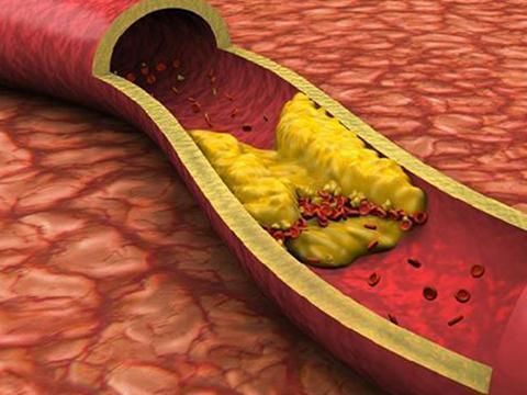 慢性疾病|身体一旦出现这些情况, 说明你体内血脂太高了!