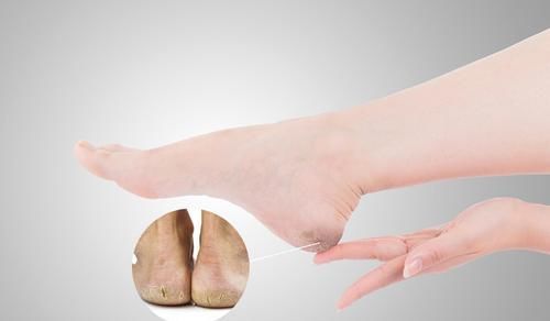  脚后跟干裂脱皮不用愁，教你一个土方法，轻松解决，省钱又实用