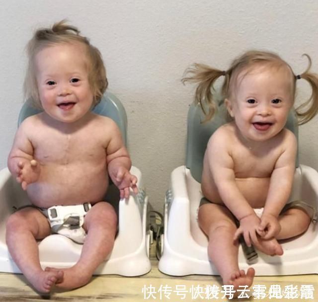 新生儿|有“唐氏综合征”的孩子,面部是什么样子?婴儿期能看出来吗