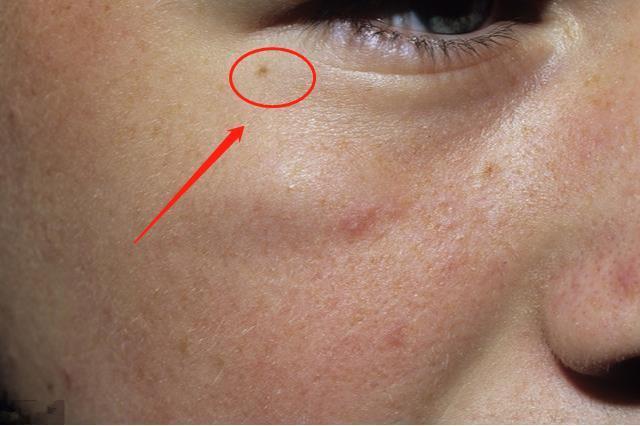 眼角膜|血脂高不高,看脸如果脸上有4种表现,要注意降低血脂了