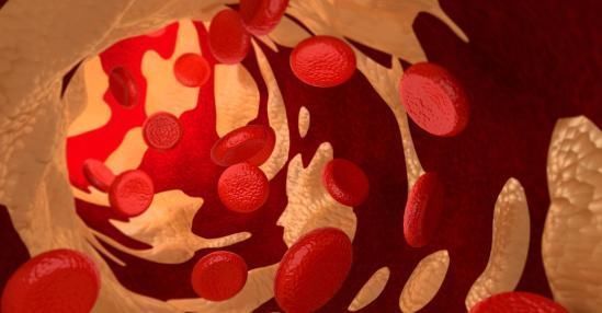 净化器|血液“净化器”被发现,预防高血脂、血栓,血管被“扫”干净了!