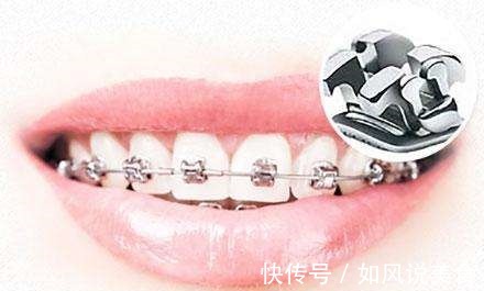 正畸|儿童做牙齿矫正三个最佳时间家长要牢记,矫治越早干预效果越好