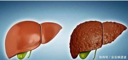 肝脏|肝硬化才不会“悄无声息”,早期信号一定别忽视,还好早知道