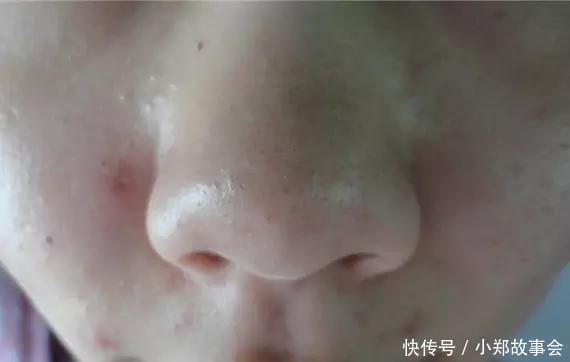 黑头|先别慌着挤黑头,这3种原因你知道了再挤也不迟
