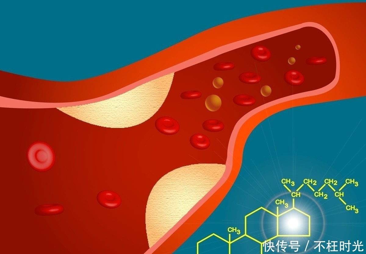 三高|体检时发现了斑块,一定要吃阿司匹林么,还要注意什么?