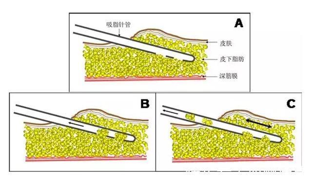 大长腿 大腿吸脂的价格多少钱？内附术后对比图日记~
