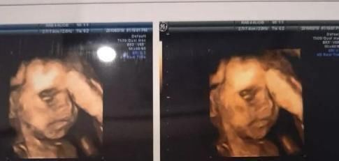 检查|四维彩超,孕妈可能更需要“了解”这几件事,否则花钱还伤胎