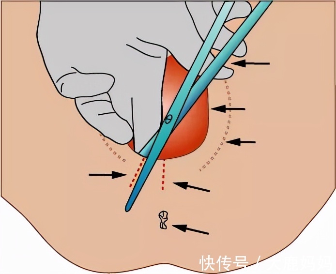 凯格尔|剖腹产和顺产究竟哪个好？听谁的？