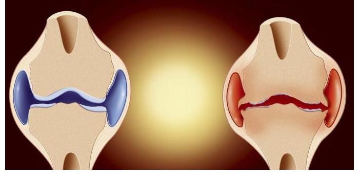 破骨细胞|骨疏松“加速器”找到了,北大院士呼吁:“2黑”要少吃,“3事”要多做