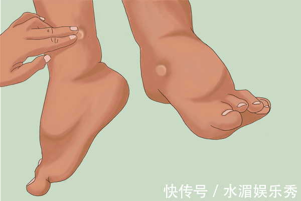 发红|肝硬化先上手脚，手脚的哪些变化，暗示了肝硬化可能找上门了？